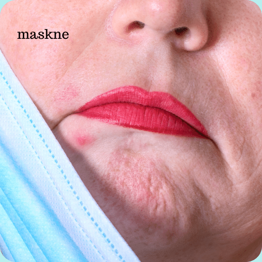 aggravate acne and maskne
