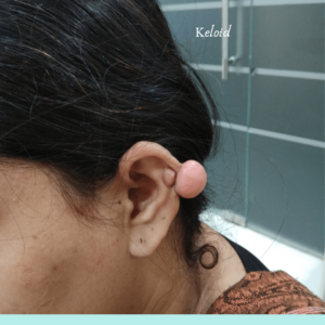Keloid Picture for dermatosurgery