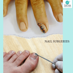Nail surgeries are routinely performed by dermatologists 