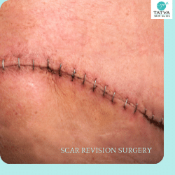 SCAR REVISION SURGERY 