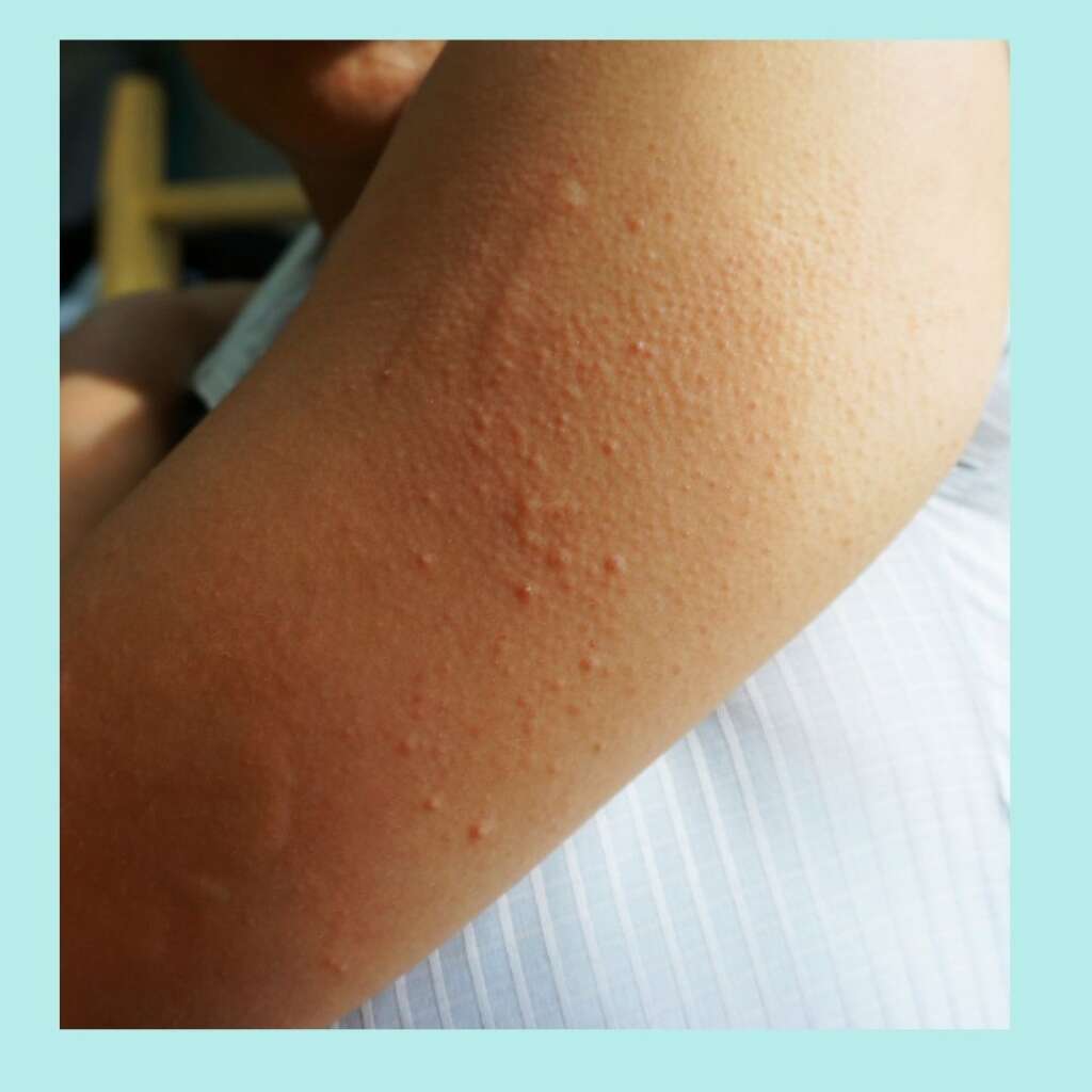 skin rash be the only symptom of COVI-19 infection