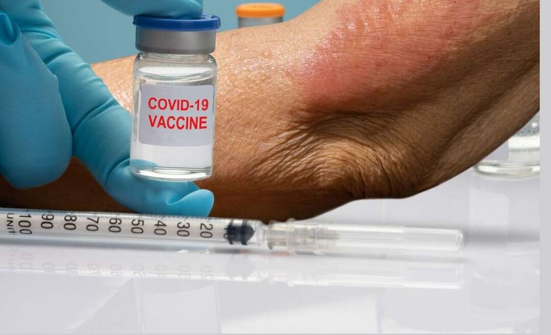 Skin rashes – COVID-19 patients