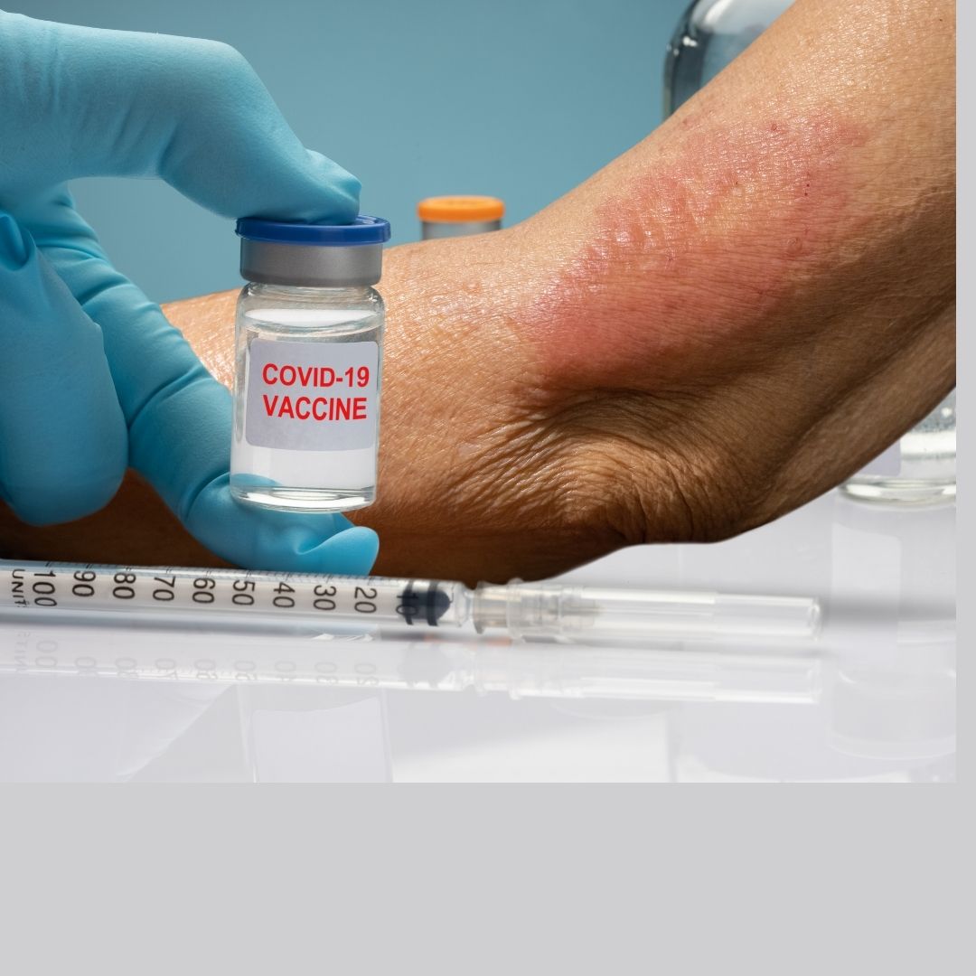 Does COVID vaccine cause any skin rash as a side effect ?
