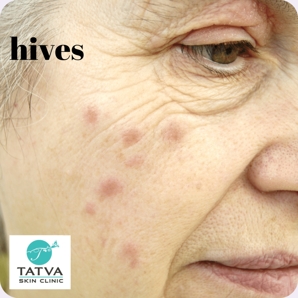 They are usually pink to red in colour and appear as bumps/welts on skin. Deeper swelling of skin and mucosa leads to angioedema.