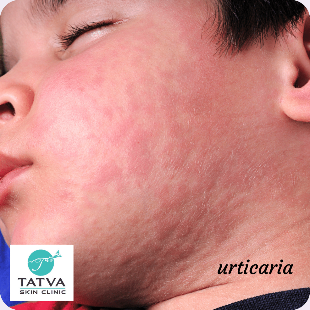 What triggers urticaria/hives