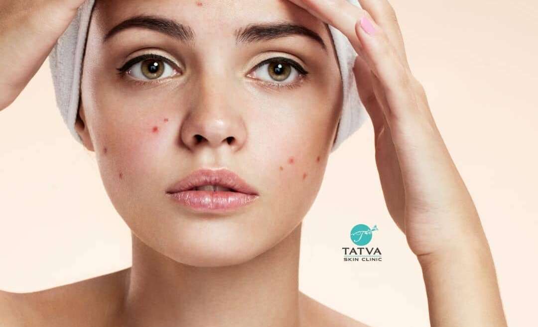 Acne vulgaris or acne or pimples