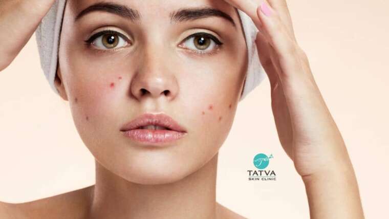 Acne vulgaris or acne or pimples