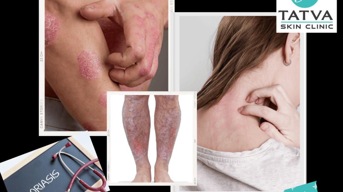 Psoriasis treatment in Tatva Skin Clinic