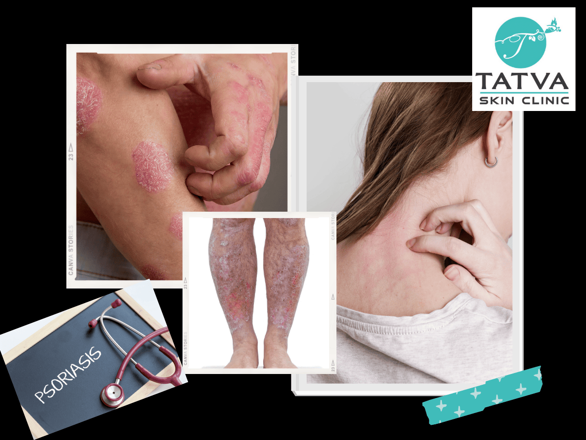 Psoriasis is a common immune mediated chronic inflammatory disease affecting skin, nail and joints.-Tatva Skin Clinic