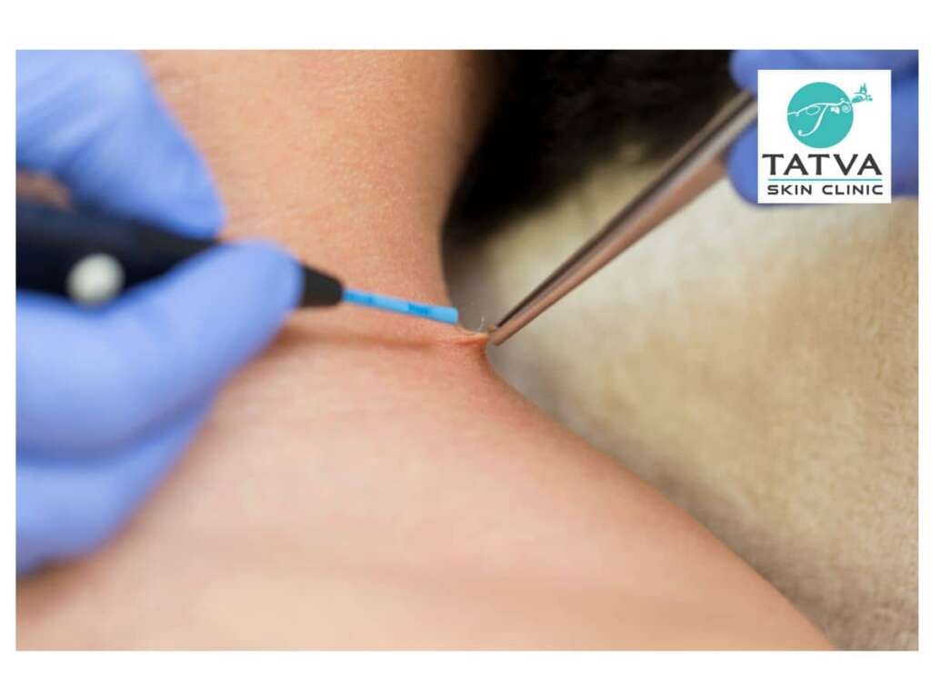 How can skin tags be removed-skin doctors