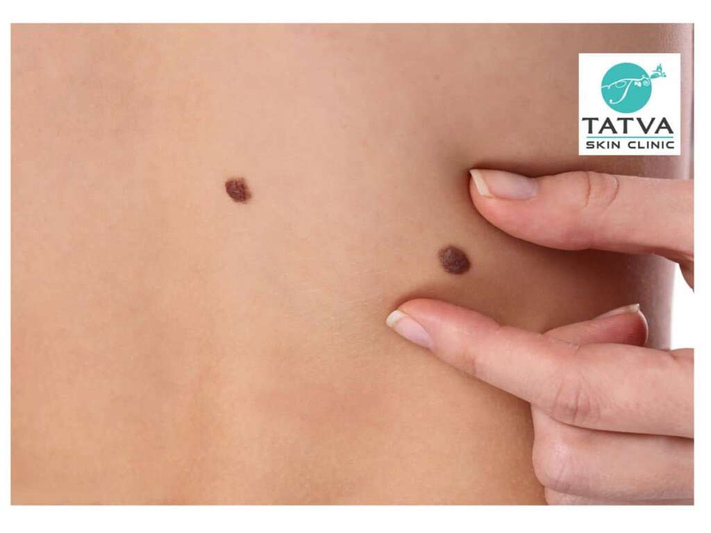 having multiple skin tags - Skin clinic in Hyderabad